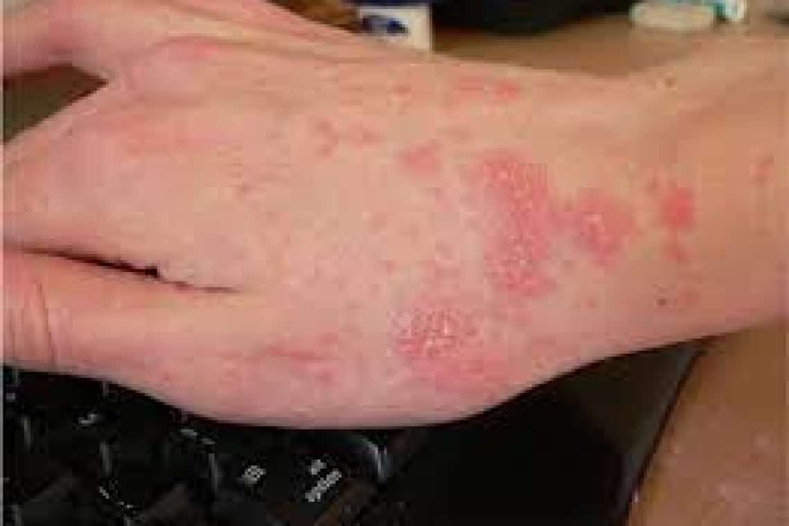 Focar de râie la Centrul pentru persoane adulte cu handicap Călinești Prahova. Ce spune directorul DGASPC Prahova