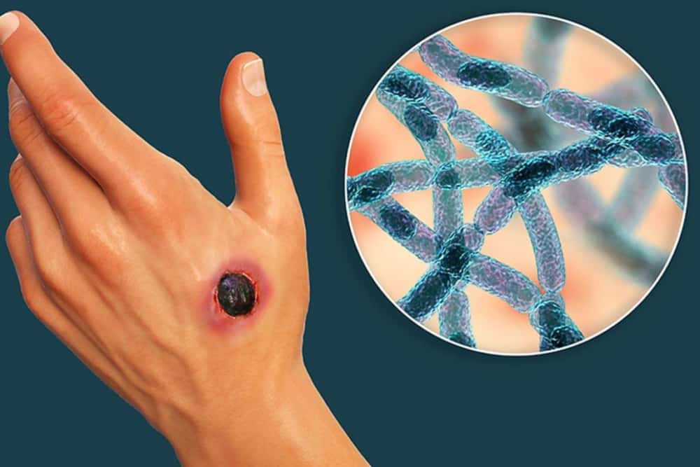 Două cazuri de antrax confirmate în România, la doi bărbați din Ialomița care au consumat carne de oaie